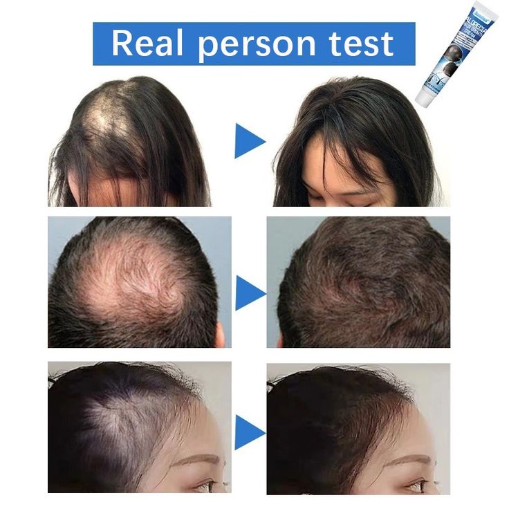 Buy Sumifun Hair Growth Cream Best Treatment for Hair Loss & regrowth